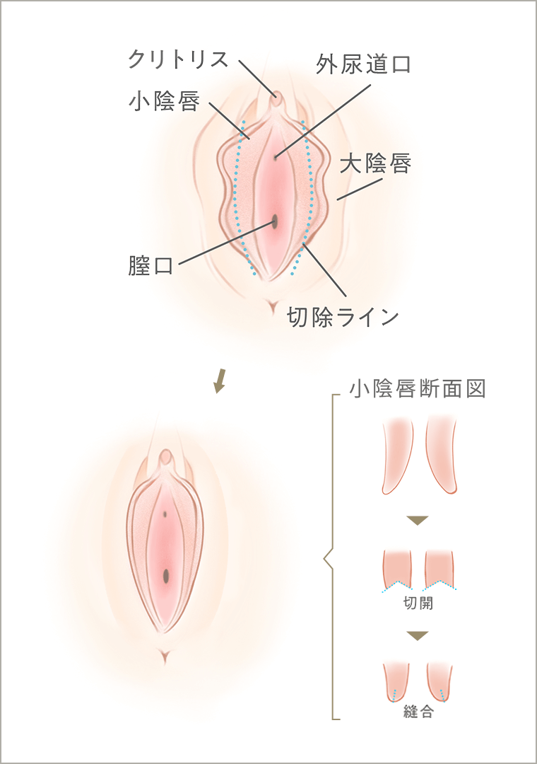 小陰唇縮小術の手術