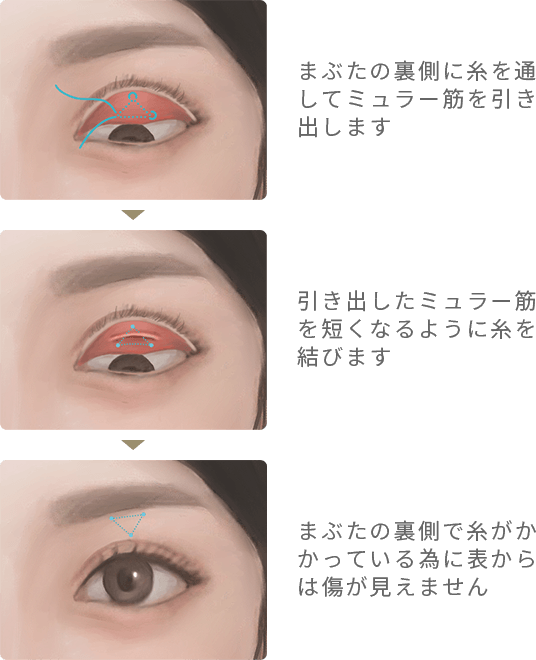 切らない眼瞼下垂の手術イラスト