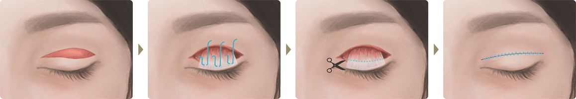 切開式眼瞼下垂の手術イラスト