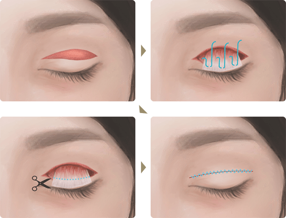 切開式眼瞼下垂の手術イラスト