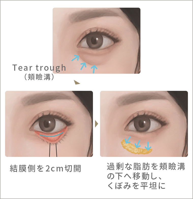 裏ハムラ法の手術