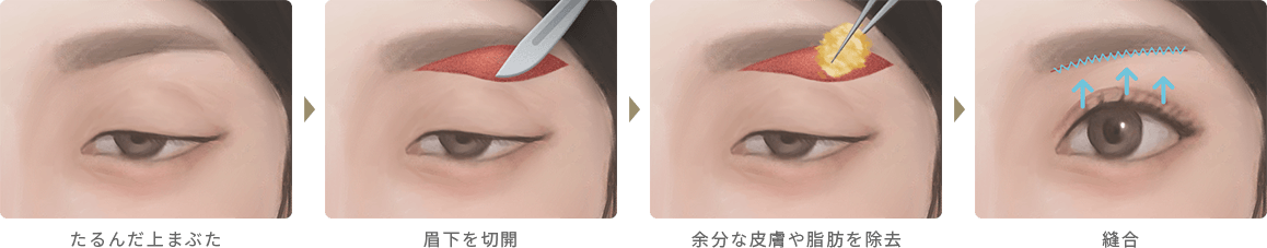 眉下切開の適応と手術