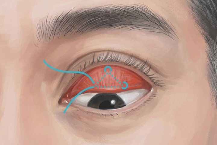 眼瞼下垂手術のイメージ。まぶたの裏側に糸を通して筋肉を調整する
