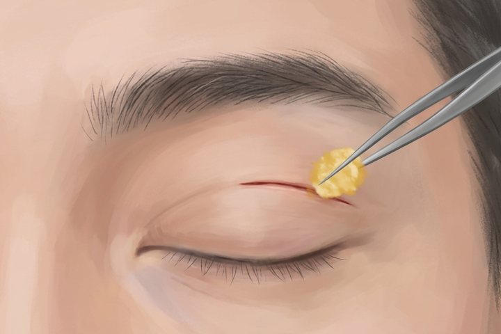 上まぶたの脂肪取りのイメージ。小さな切開から脂肪を取り除く