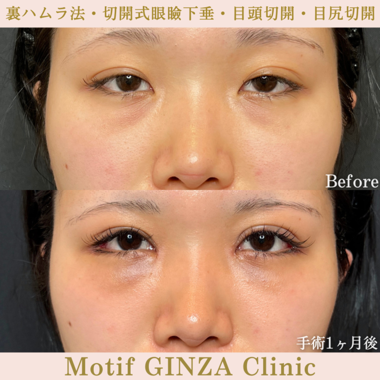 裏ハムラ法・切開式眼瞼下垂術・目頭切開・目尻切開(手術6か月)の写真6