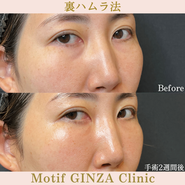裏ハムラ法（手術３か月）の写真6