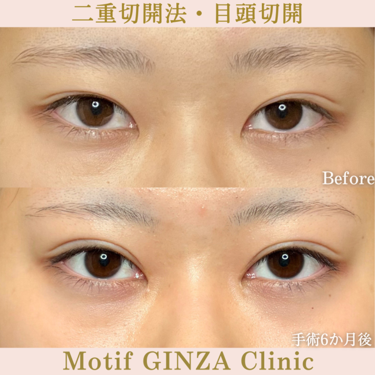 二重切開法・目頭切開（手術6か月）