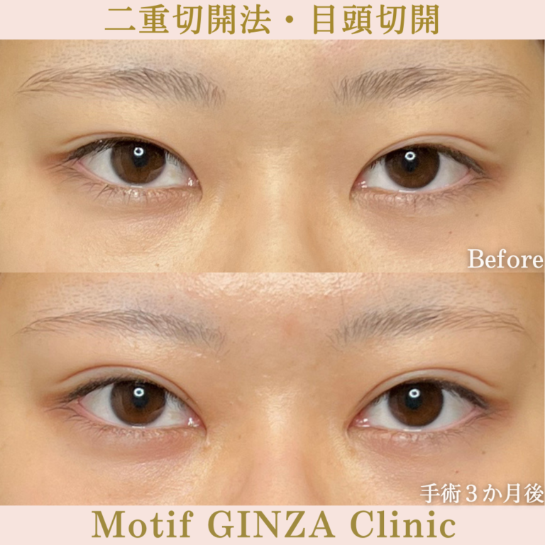 二重切開法・目頭切開（手術３か月）