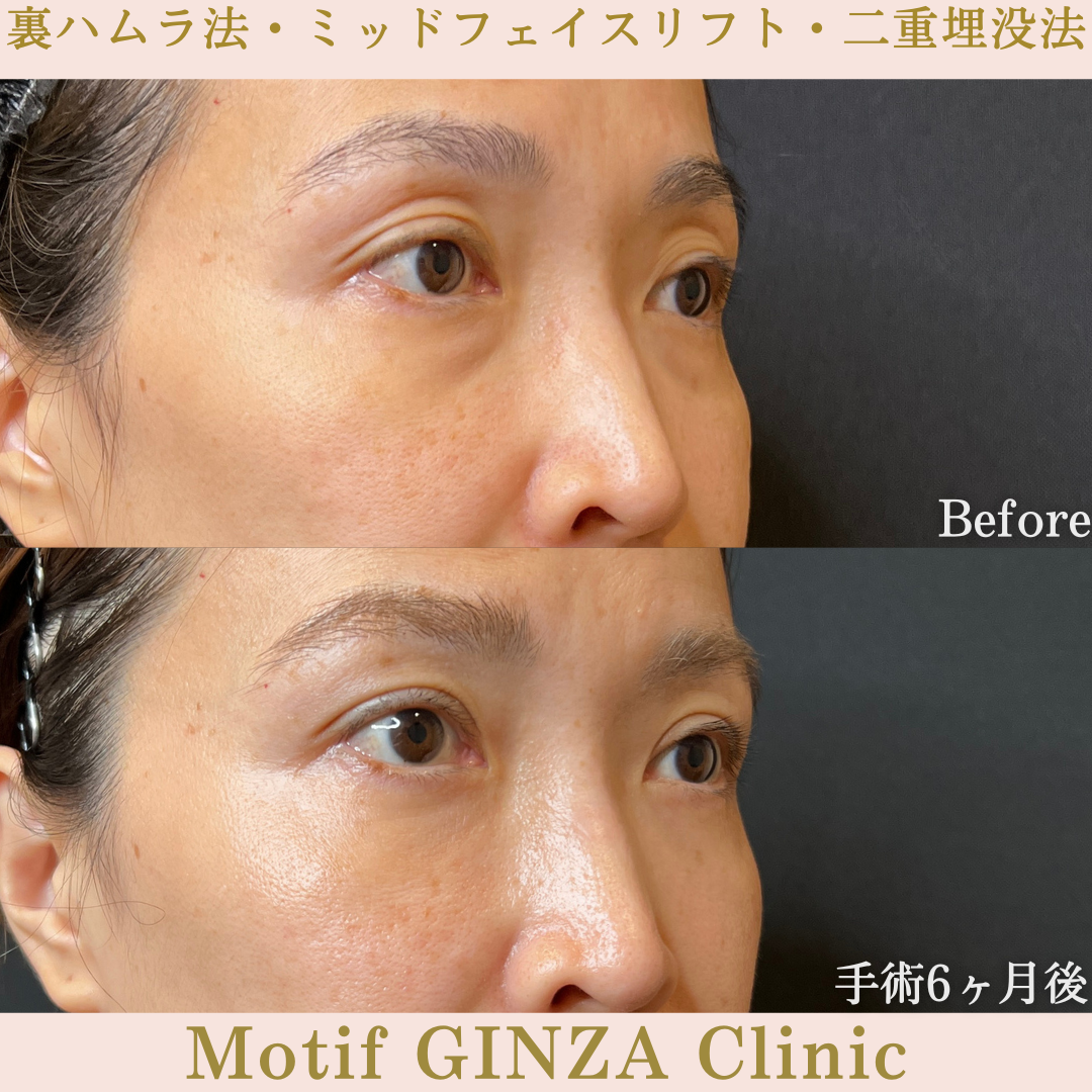 裏ハムラ法・ミッドフェイスリフト・二重埋没法（手術６ヶ月）の写真3