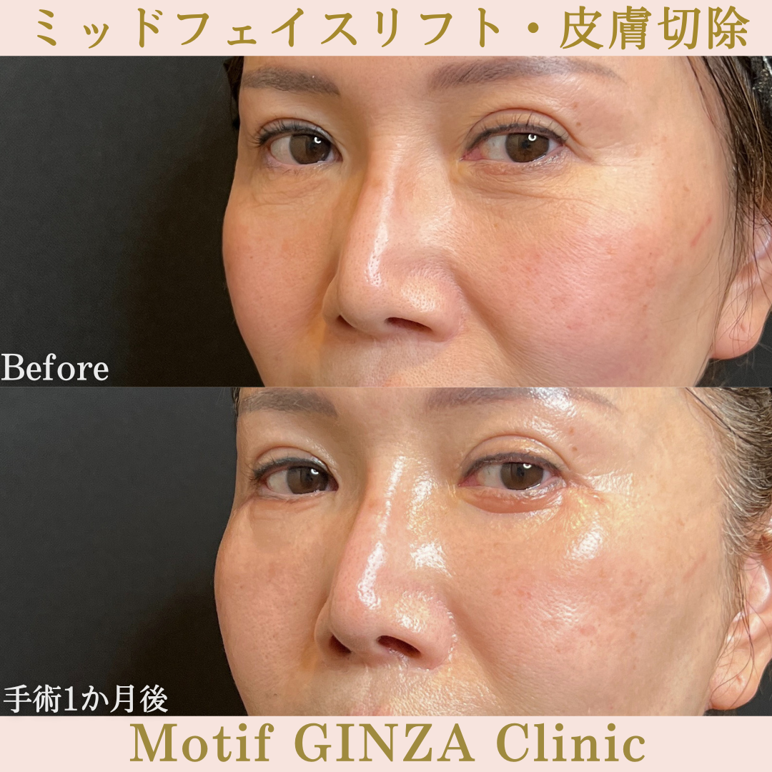 ミッドフェイスリフト・皮膚切除(手術6か月)の写真6