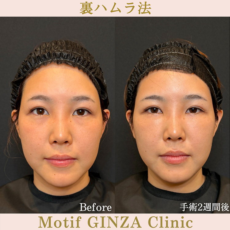 裏ハムラ法を受けた30代女性患者様の術前写真