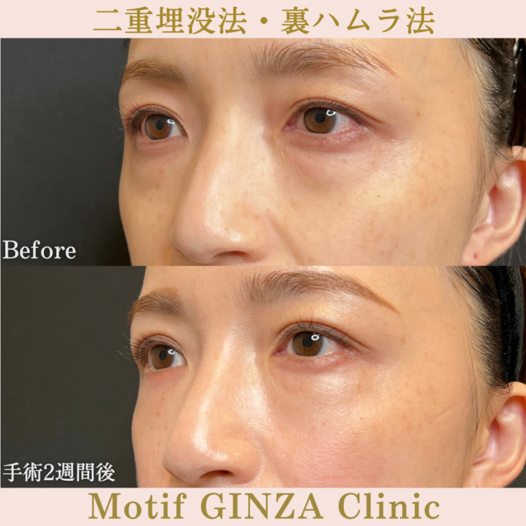 二重埋没法・裏ハムラ法（手術３か月）の写真6