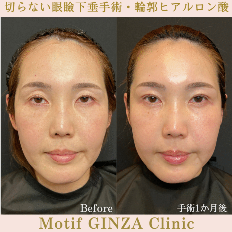 切らない眼瞼下垂手術・輪郭ヒアルロン酸(手術1か月)