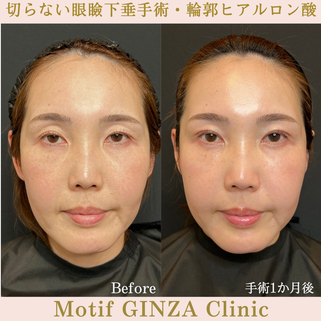 切らない眼瞼下垂手術・輪郭ヒアルロン酸（手術１か月）の写真
