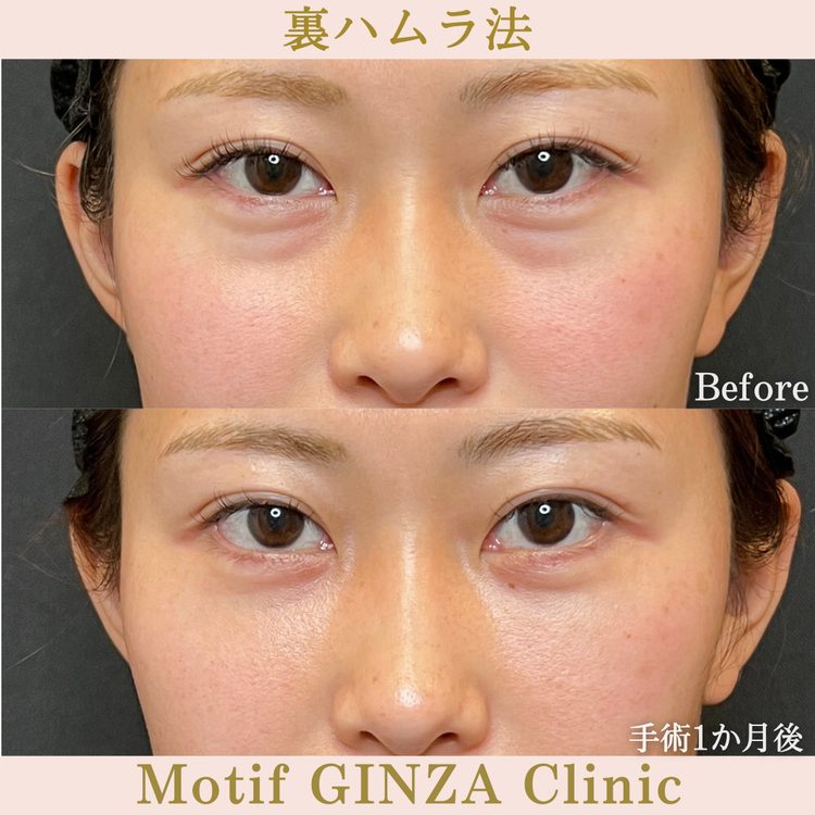 裏ハムラ法の症例写真（術前・術後比較）