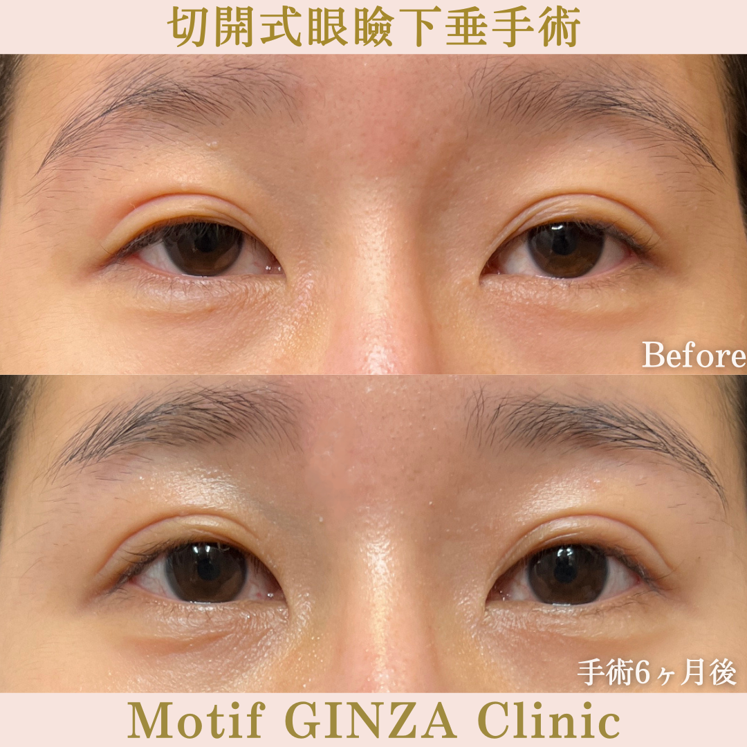 切開式眼瞼下垂手術（手術６ヶ月）の写真