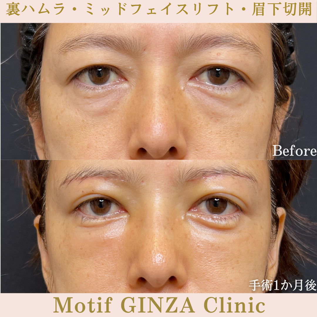 裏ハムラ法・ミッドフェイスリフト・眉下切開（手術６か月）の写真5