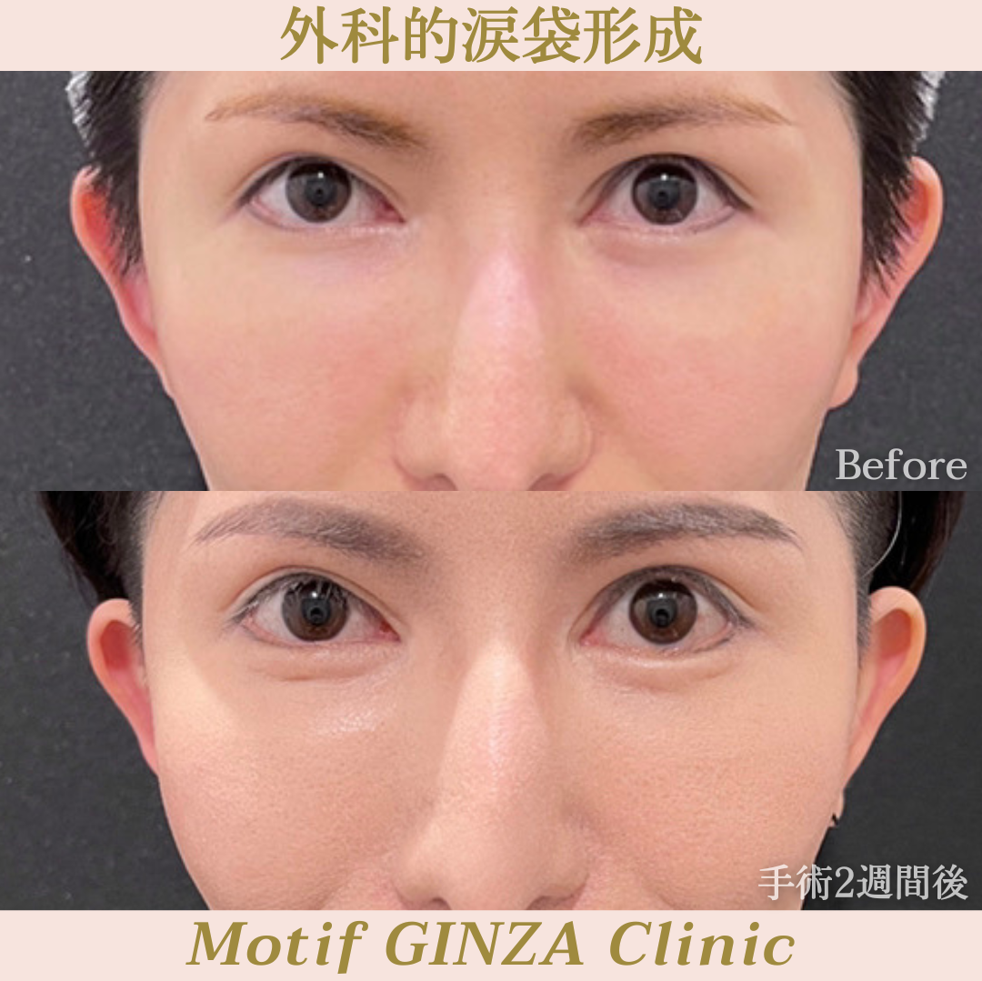 外科的涙袋形成(手術3ヶ月)の写真4