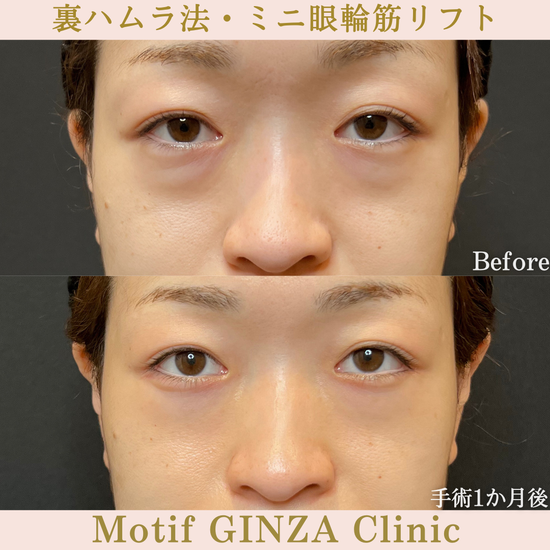 裏ハムラ法・ミニ眼輪筋リフト（手術1年8か月）の写真3