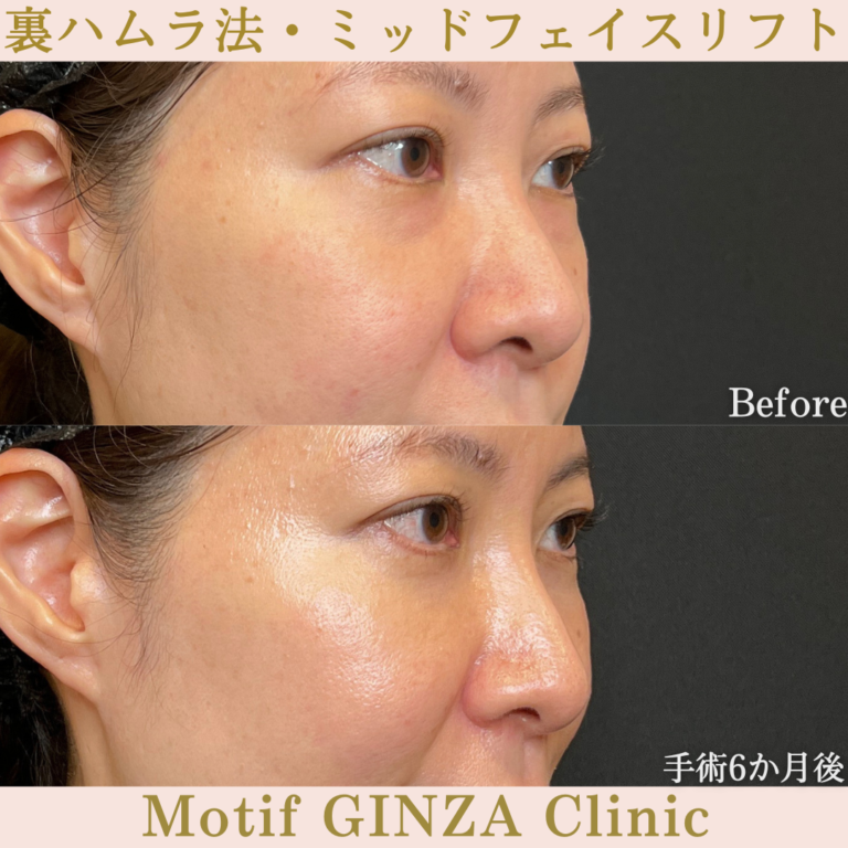 裏ハムラ法・ミッドフェイスリフト(手術6か月)の写真2