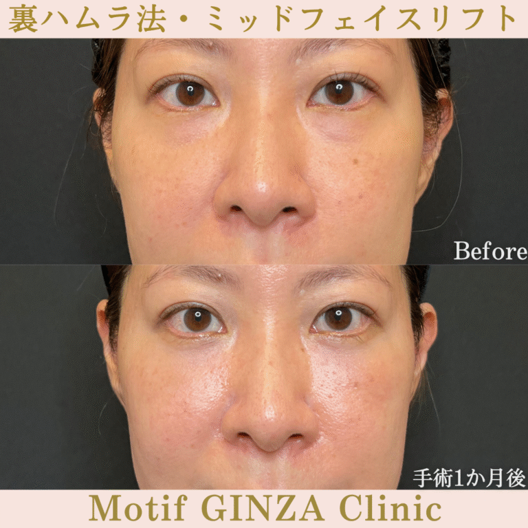 裏ハムラ法・ミッドフェイスリフト（手術３か月）の写真3