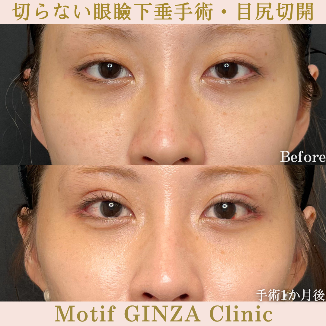 切らない眼瞼下垂手術・目尻切開(手術3か月)の写真2