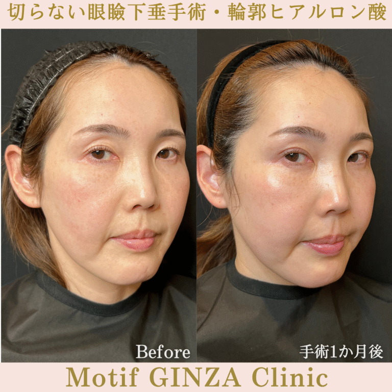 切らない眼瞼下垂手術・輪郭ヒアルロン酸（手術１か月）の写真2
