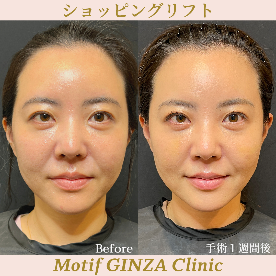 ショッピングリフト(手術2週間)の写真3