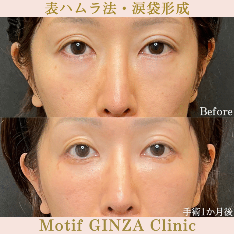 表ハムラ法・涙袋形成（手術３か月）の写真3