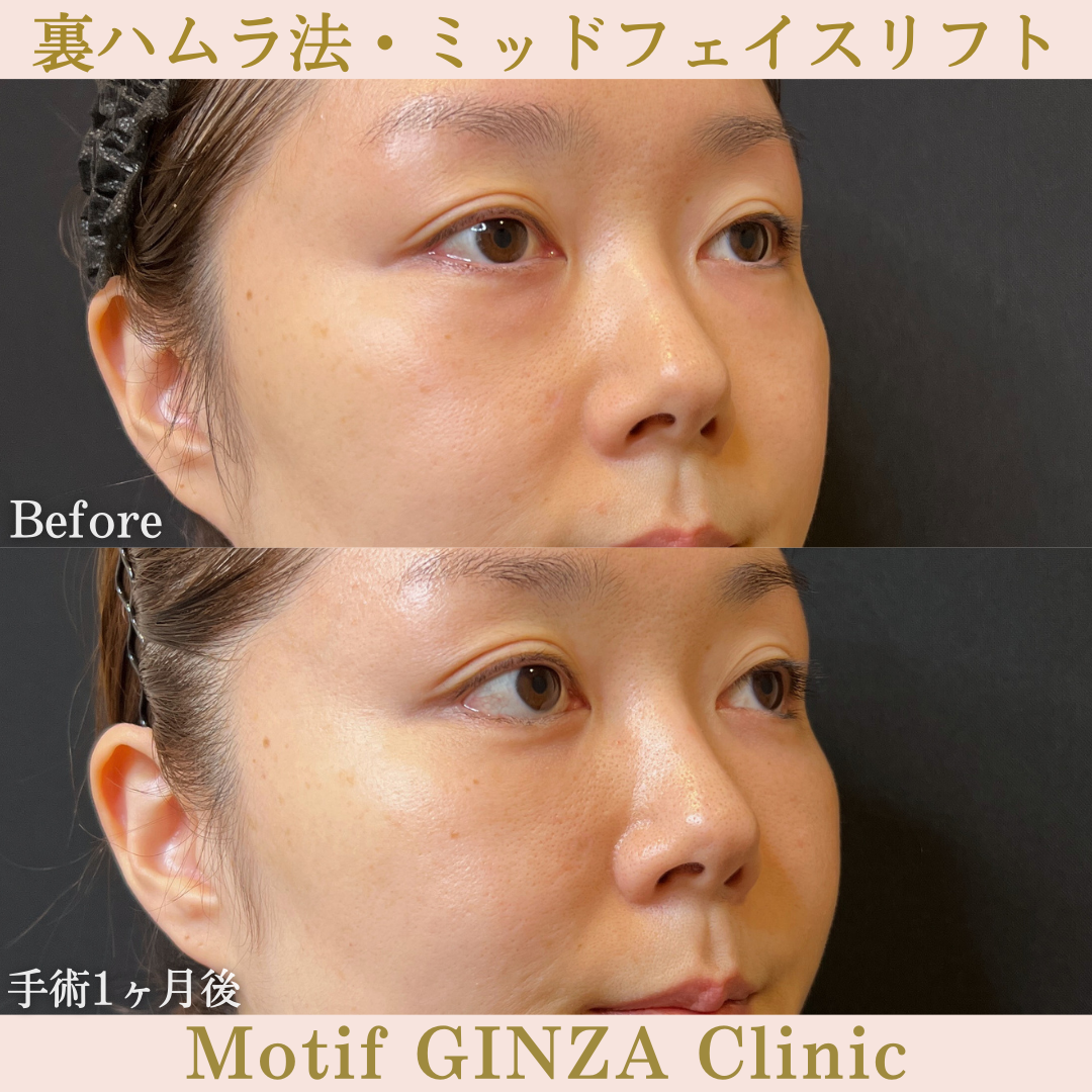 裏ハムラ法・ミッドフェイスリフト（手術１ヶ月）の写真3
