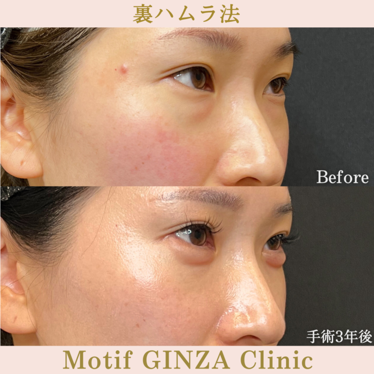 裏ハムラ法（手術3年）の写真2