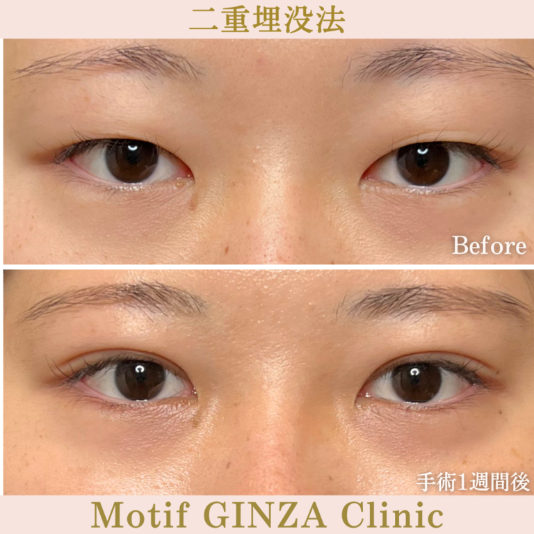 二重埋没法法（手術１か月）の写真2