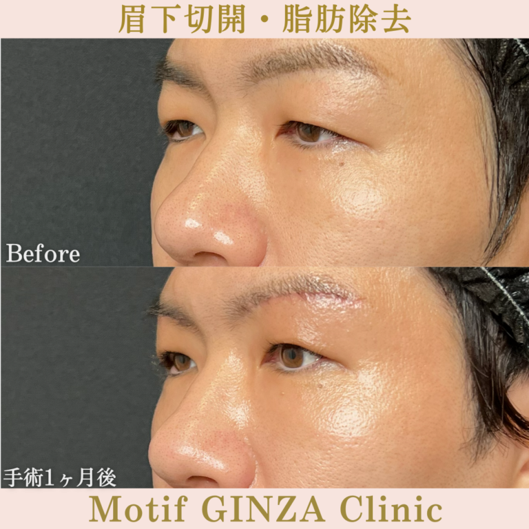 眉下切開・脂肪除去(手術3か月)の写真4