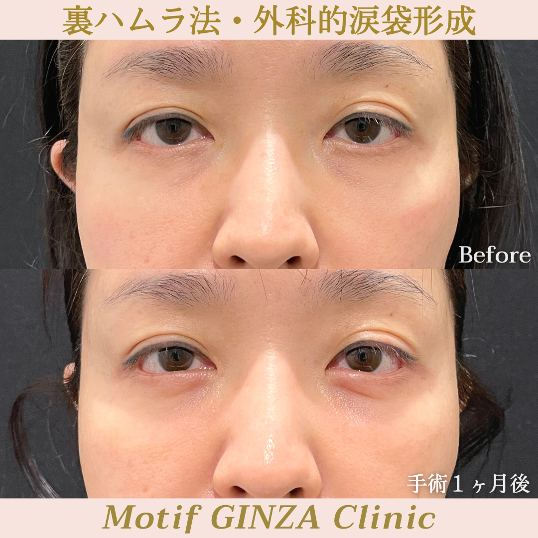 裏ハムラ法・外科的涙袋形成(手術3ヶ月)の写真3