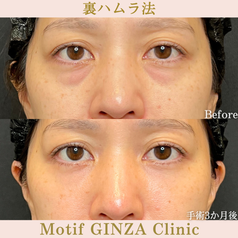 裏ハムラ法（手術3か月）