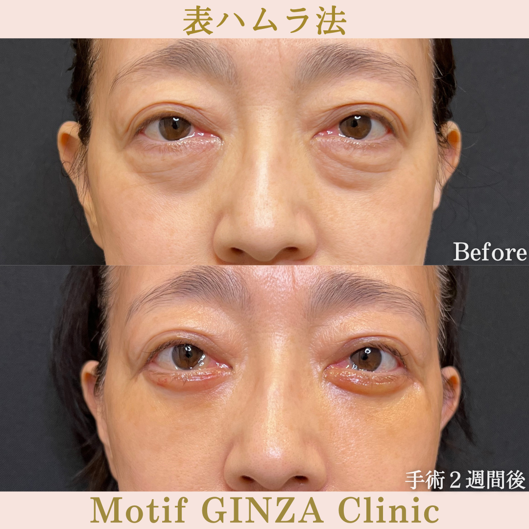 切開式下眼瞼たるみ取り（手術６ヶ月）の写真5