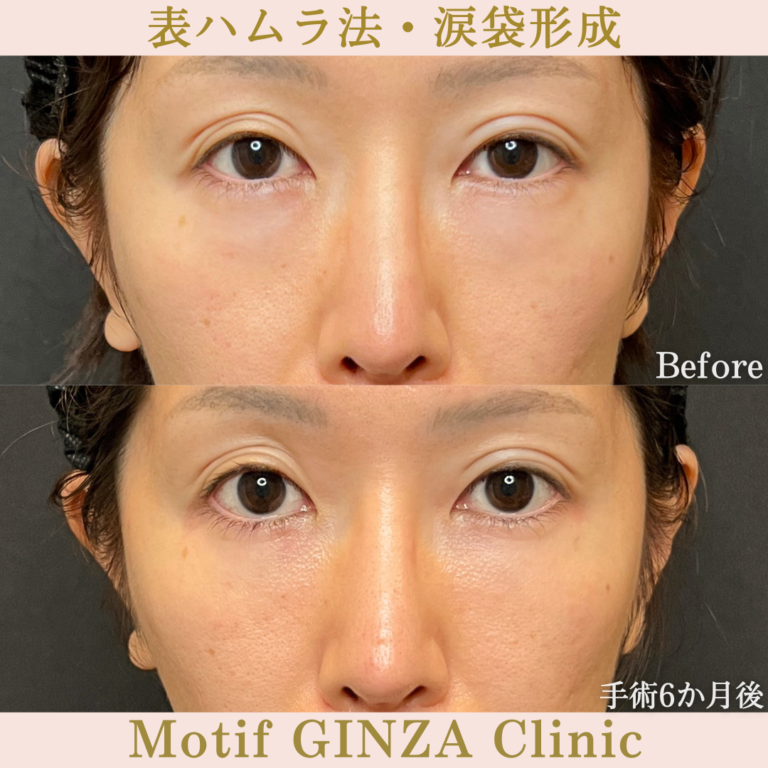表ハムラ法・涙袋形成（手術6か月）