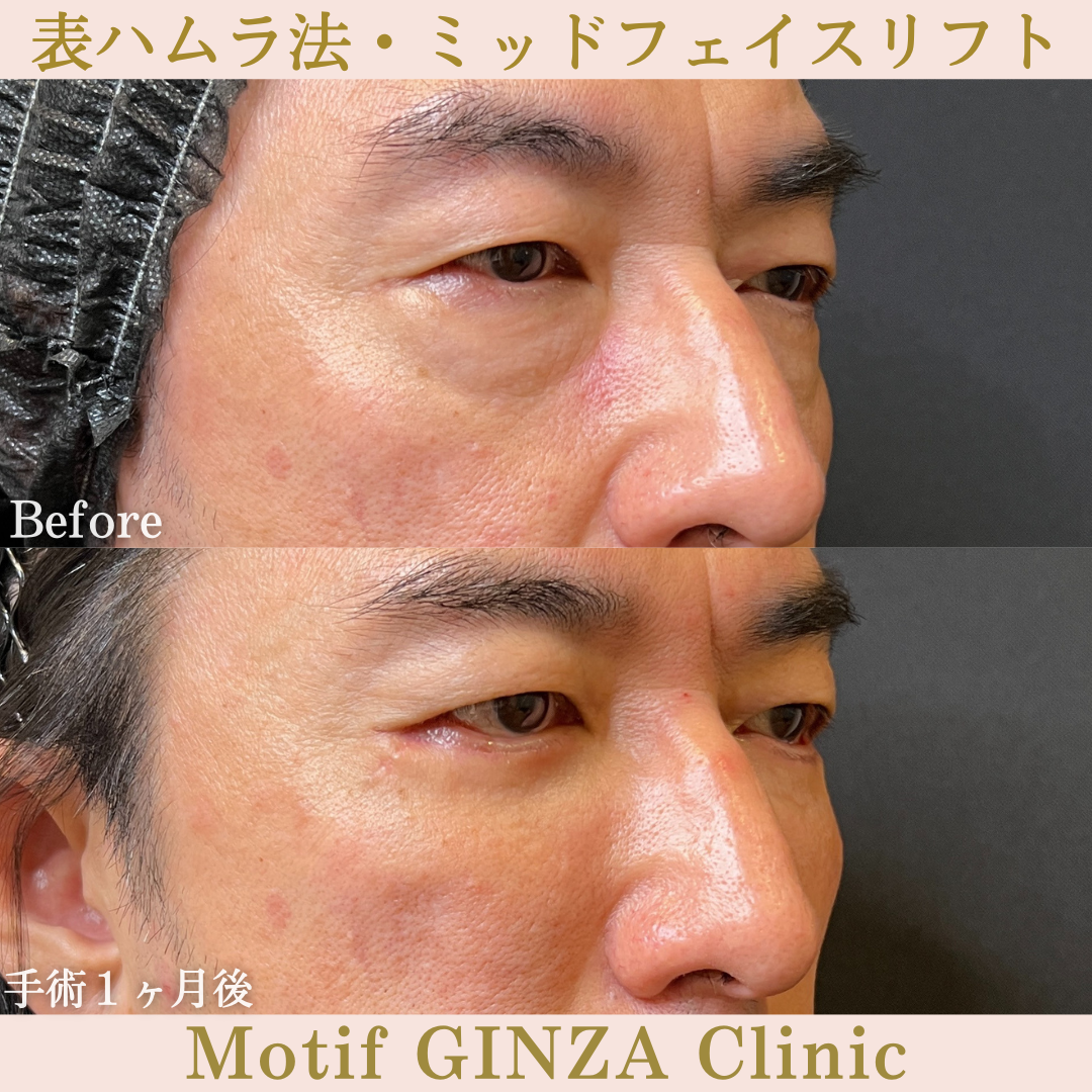 切開式下眼瞼たるみ取り・ミッドフェイスリフト(手術6ヶ月)の写真6
