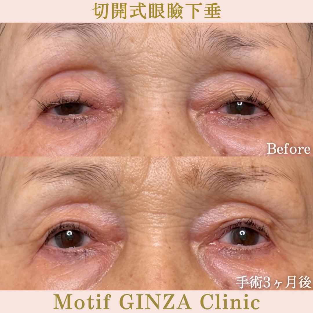 切開式眼瞼下垂手術(手術6か月)の写真3
