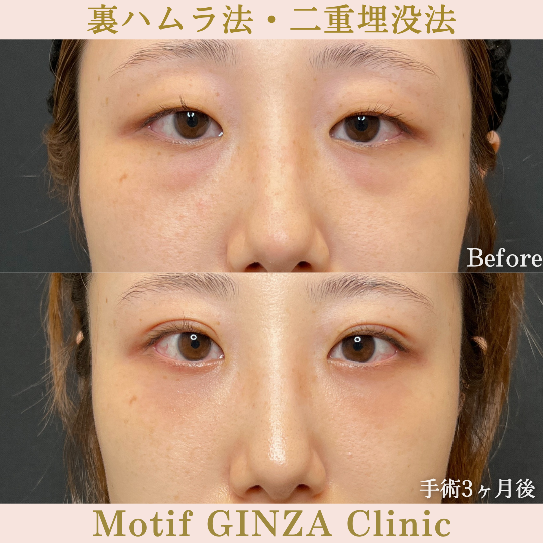 裏ハムラ法・二重埋没法(手術2年3ヶ月)の写真3