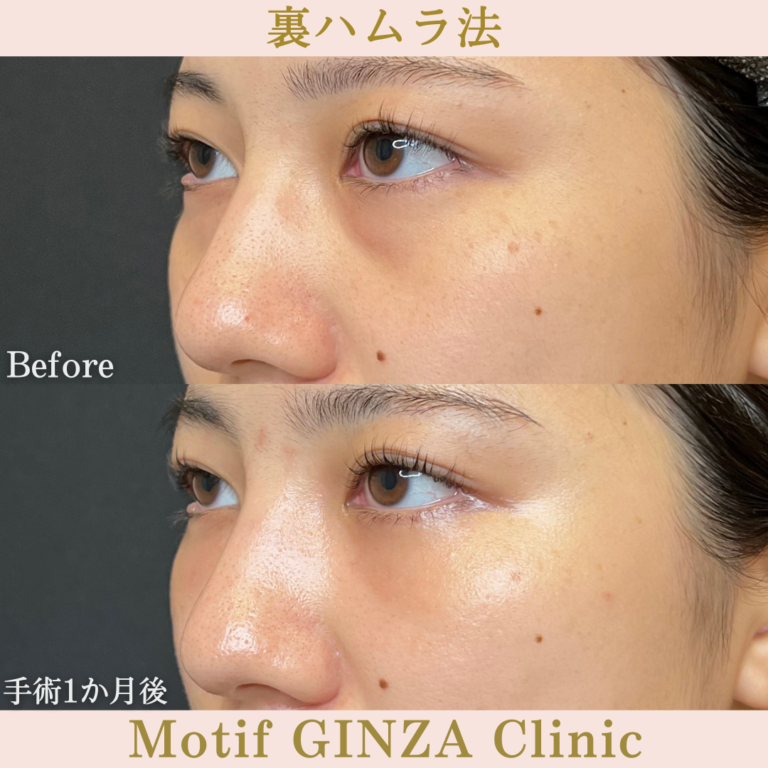 裏ハムラ法（手術３か月）の写真4