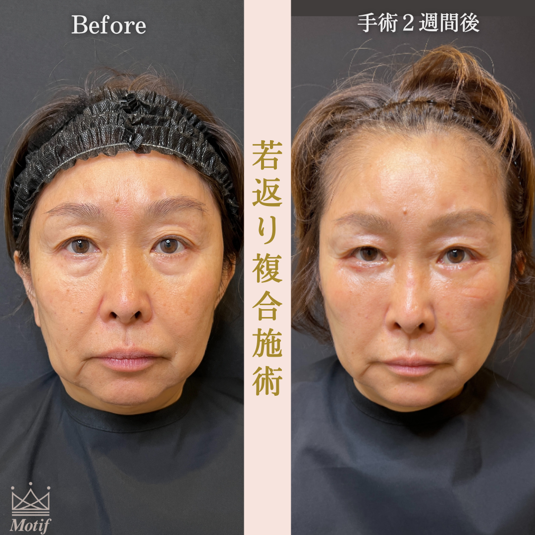 若返り複合施術（手術３ヶ月）の写真5
