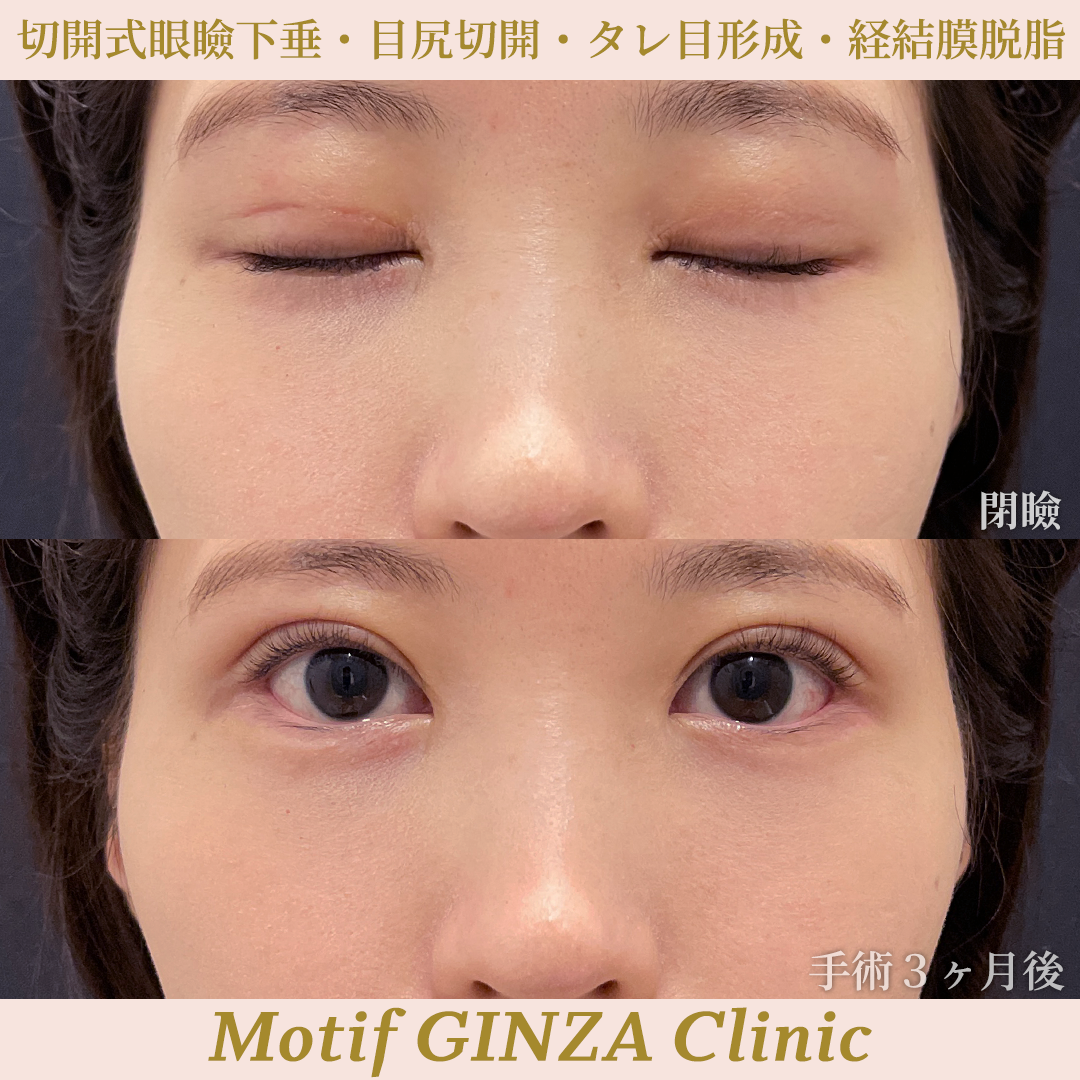 目元複合切開(手術3ヶ月)の写真2