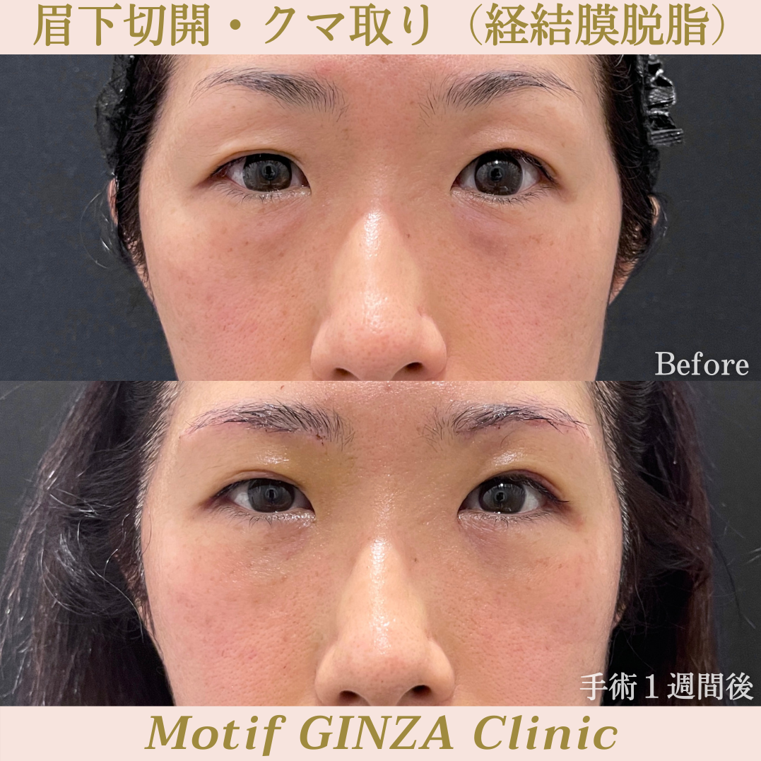 眉下切開・経結膜脱脂(手術3ヶ月)の写真5