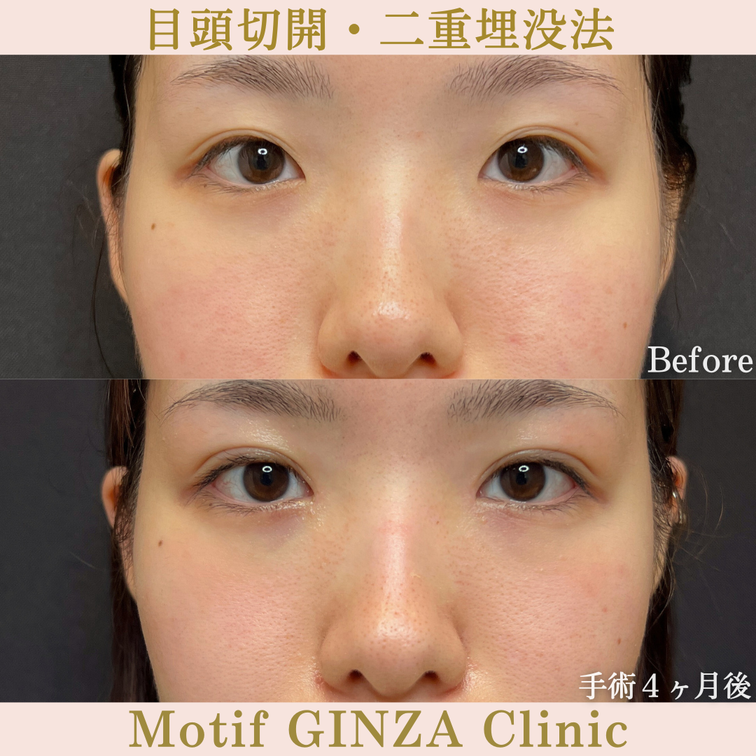 目頭切開・二重埋没法（手術６ヶ月）の写真3