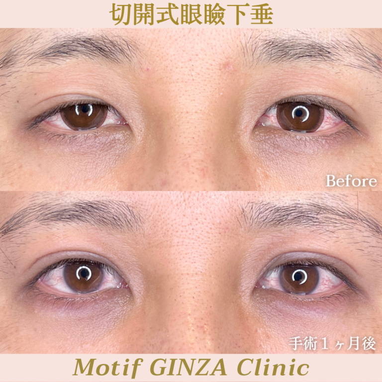 切開式眼瞼下垂手術（手術３ヶ月）の写真3