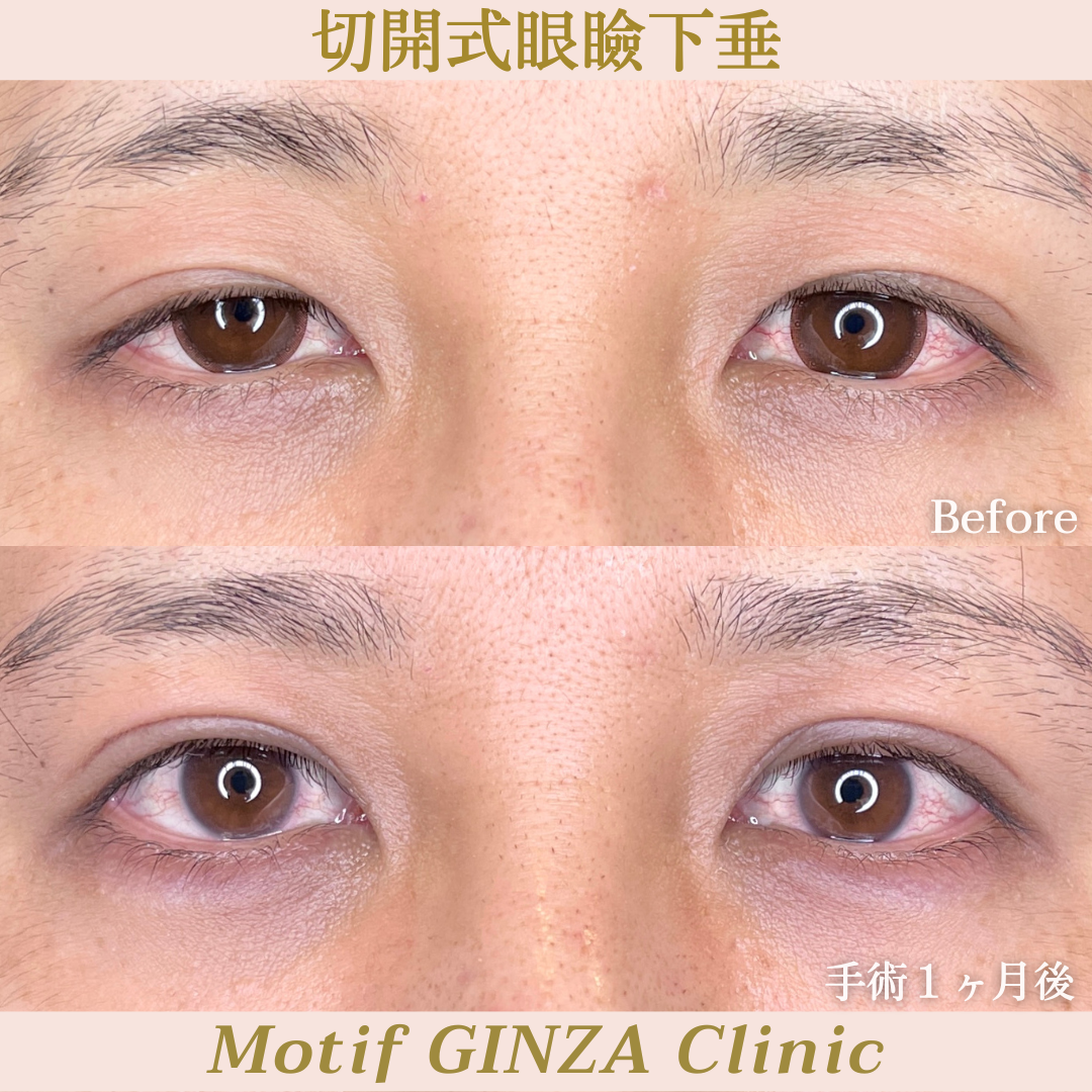 切開式眼瞼下垂手術（手術３ヶ月）の写真3