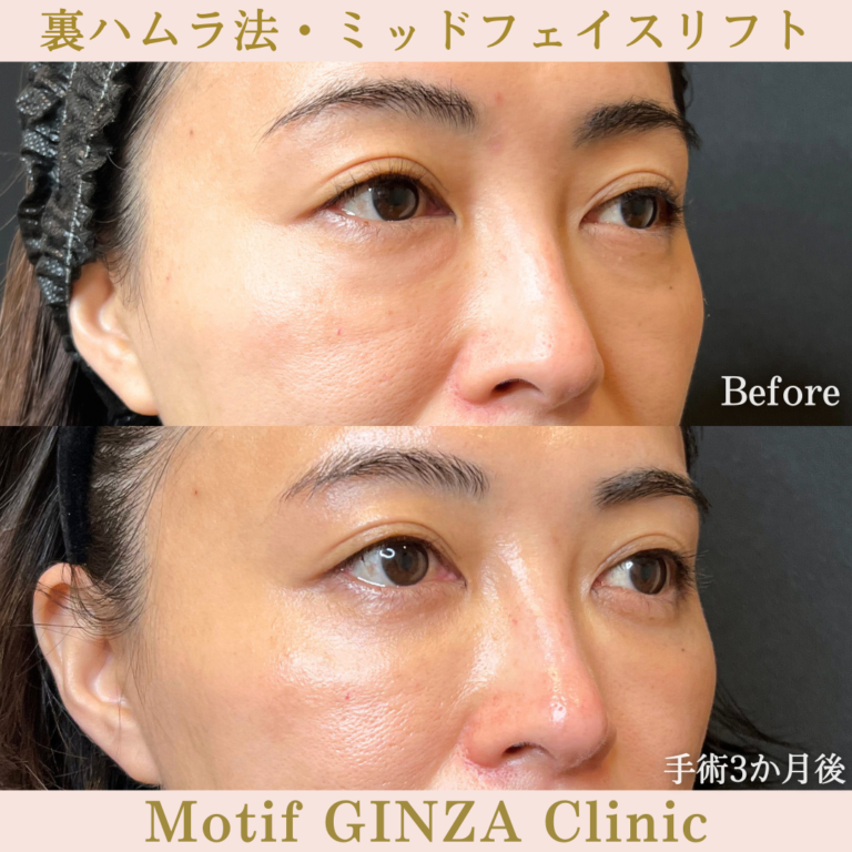 裏ハムラ法・ミッドフェイスリフト(手術3か月)の写真2