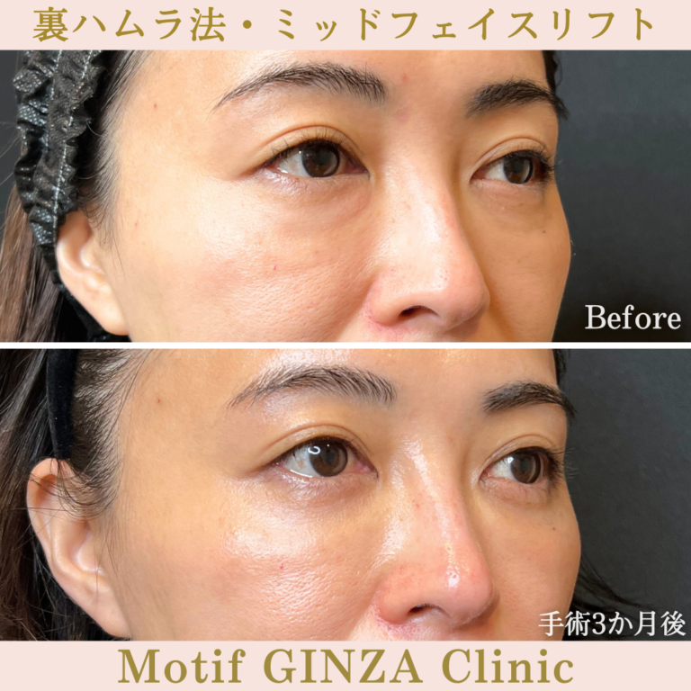 裏ハムラ法・ミッドフェイスリフト（手術３か月）の写真2