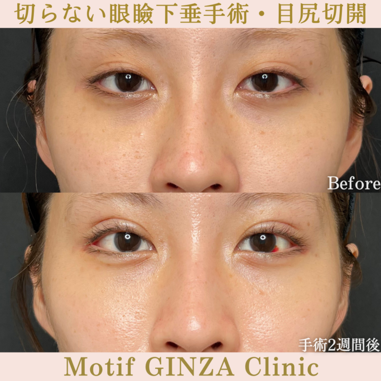 切らない眼瞼下垂手術・目尻切開(手術3か月)の写真3